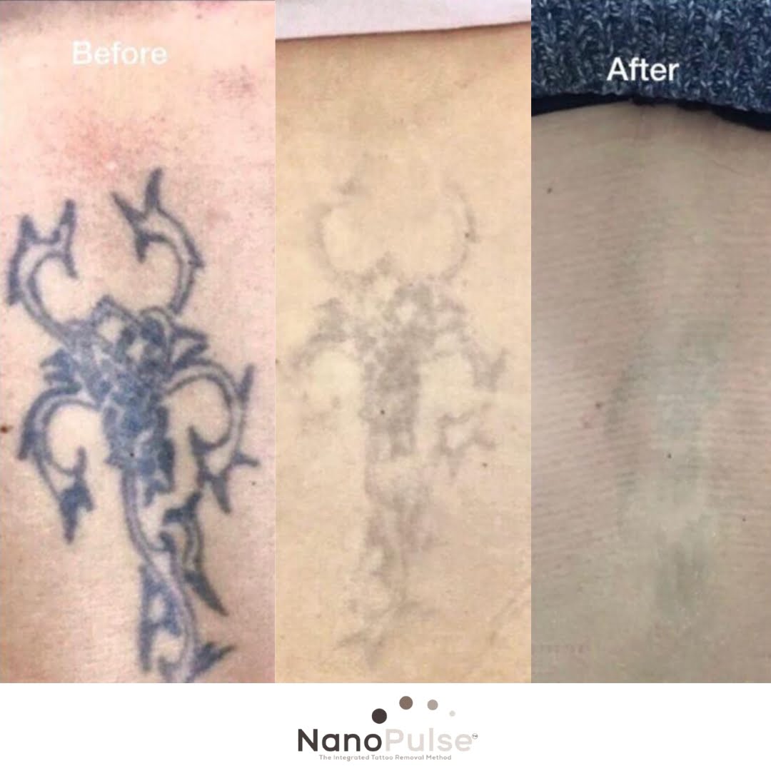NanoPulse Tattoo Removal